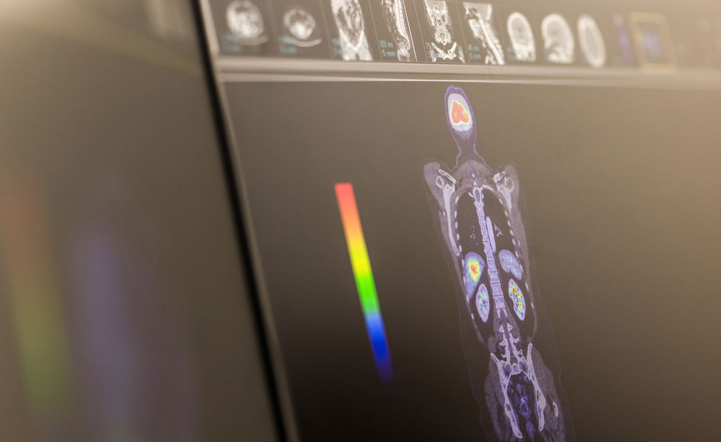 PET/CT Scan Queensland XRay