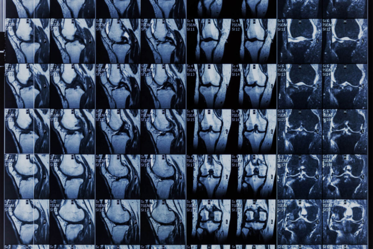 Musculoskeletal MRI Queensland XRay